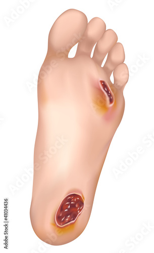 Diabetic foot.