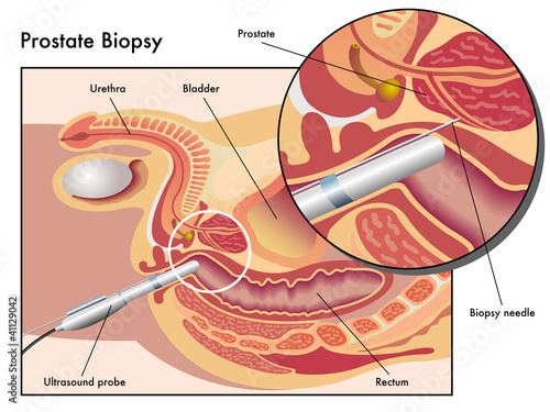 Biopsia prostatica