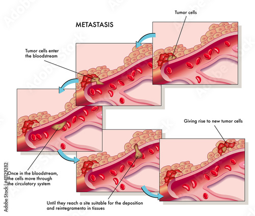 metastasi photo
