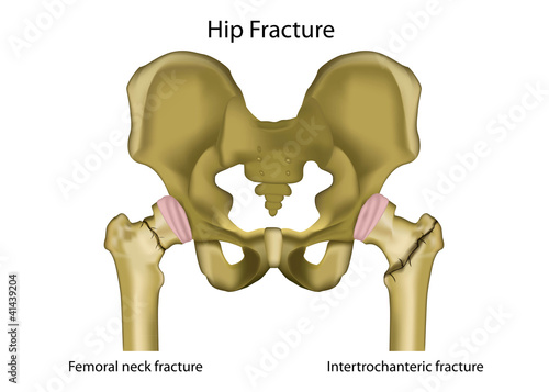 hip joint fracture medical vector illustration,english