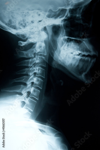 Neck injury