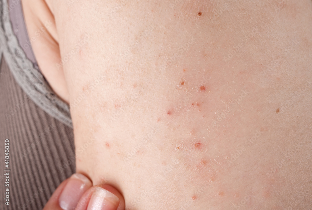allergic rash dermatitis allergic rash dermatitis