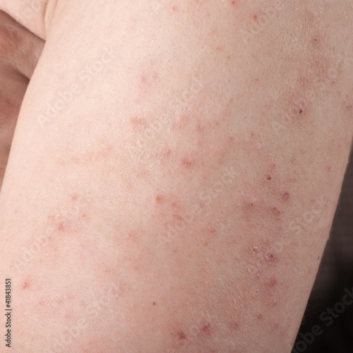 allergic rash dermatitis
