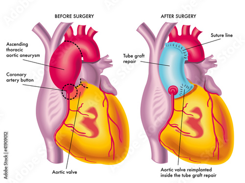 aneurisma aortico toracico photo