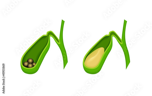 Gallstones