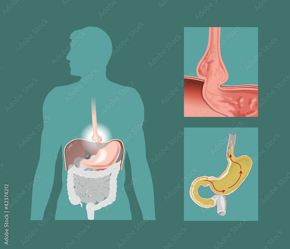Foto hiatal hernia