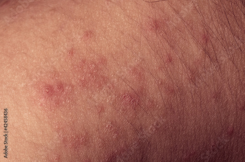 eczema atopic dermatitis symptom skin texture