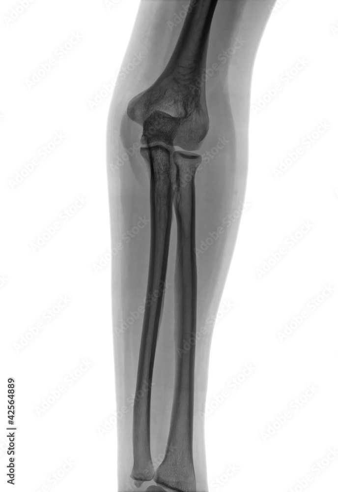 Elbow X-ray negative Elbow X-ray negative
