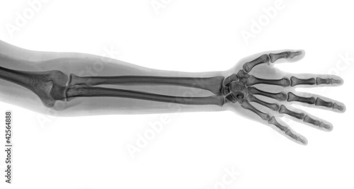 Hand x-ray photo