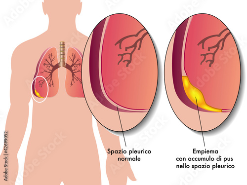enpiema pleurico