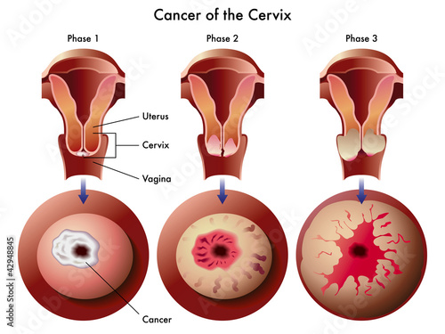 Carcinoma cervicale