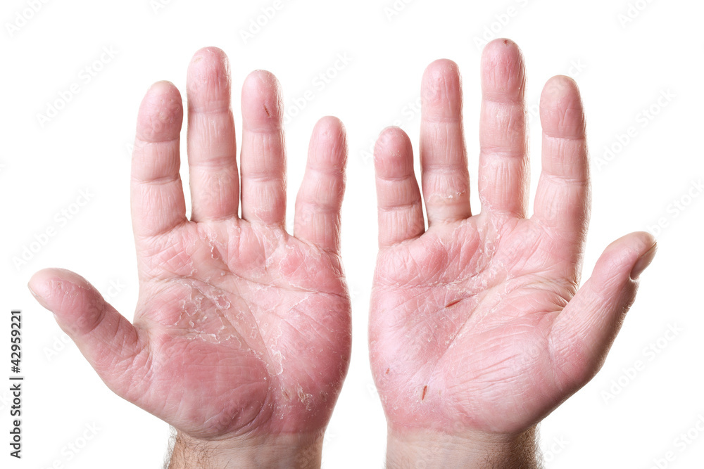 two male palms with eczema isolated on white background