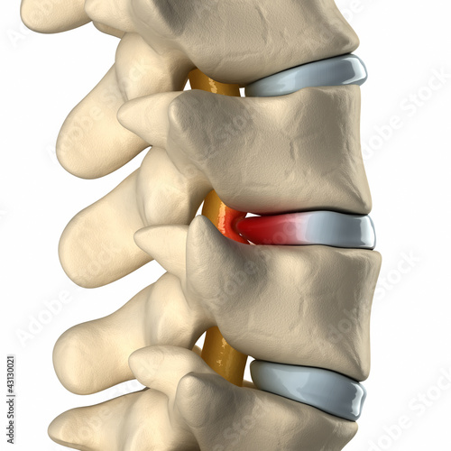 Canvas Print Spinal cord under pressure of bulging disc