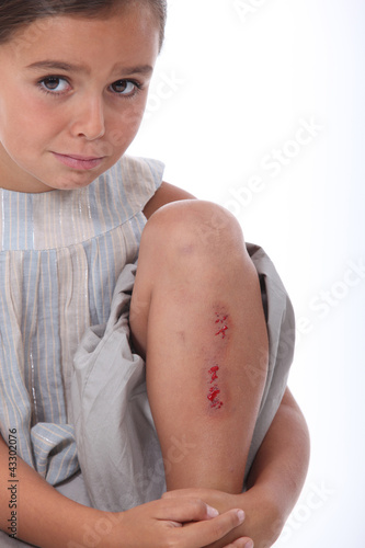Girl with a grazed leg
