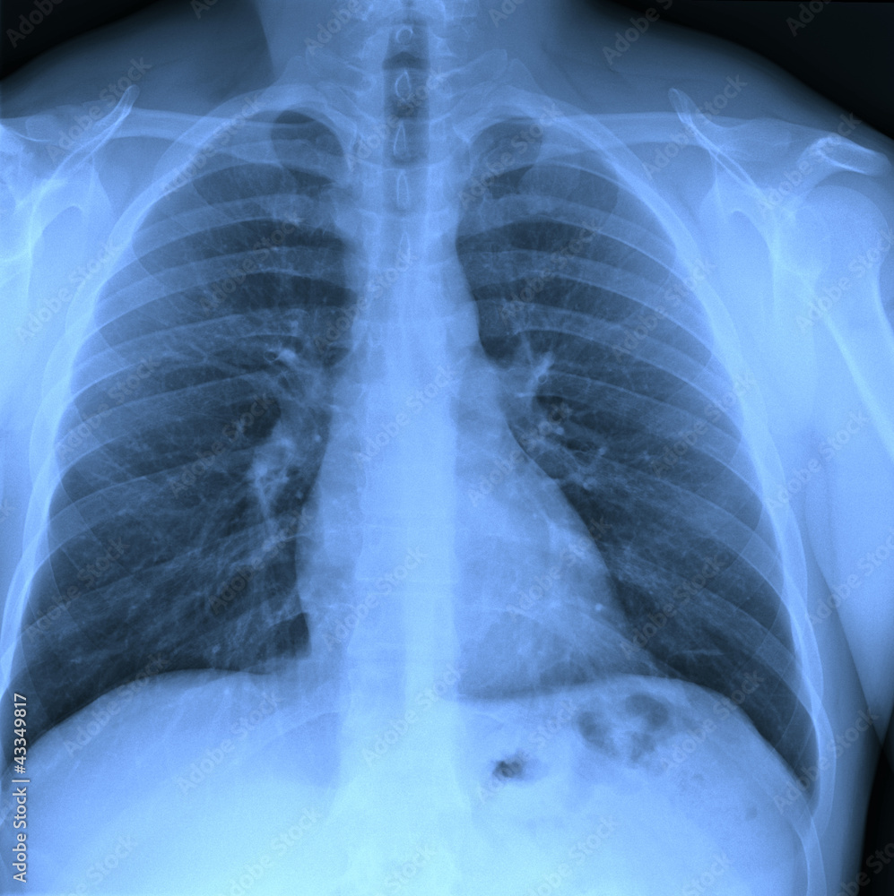 X-ray chest