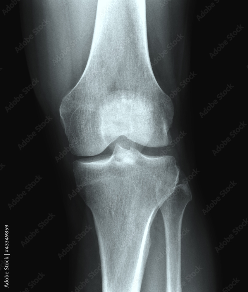 X-ray knee