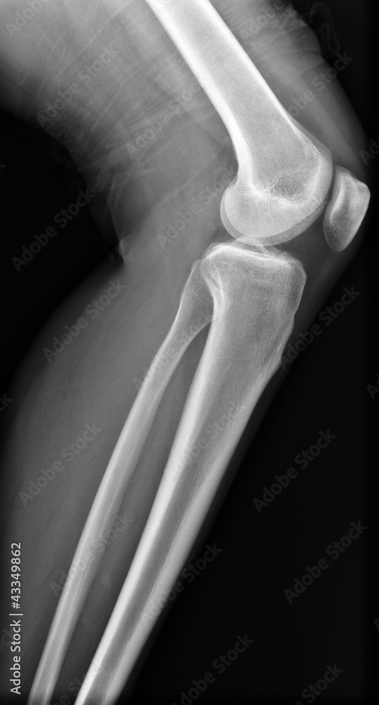 X-ray knee