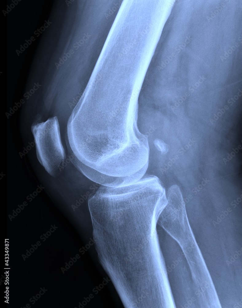 X-ray knee