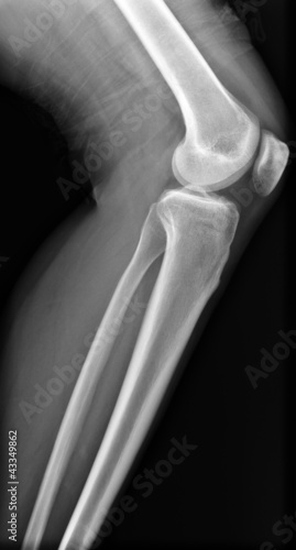 Obraz na płótnie X-ray knee w salonie