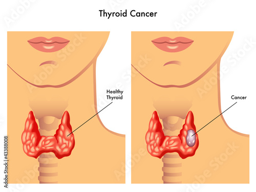 carcinoma tiroideo
