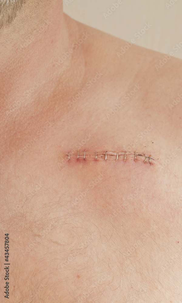 Fototapeta premium pacemaker scar