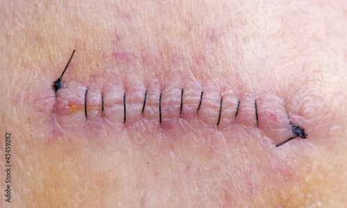 Stitches After Skin Cancer Removal