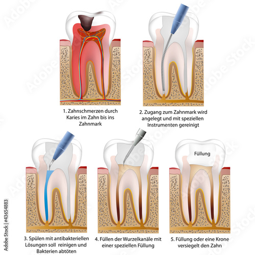 darstellung einer wurzelbehandlung, vektor illustration deutsch photo