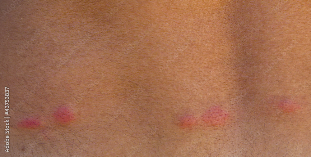 Fototapeta premium flea bites