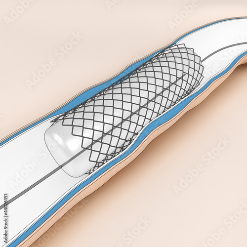 Coronary Angioplasty - ballon with stent opening lumen artery