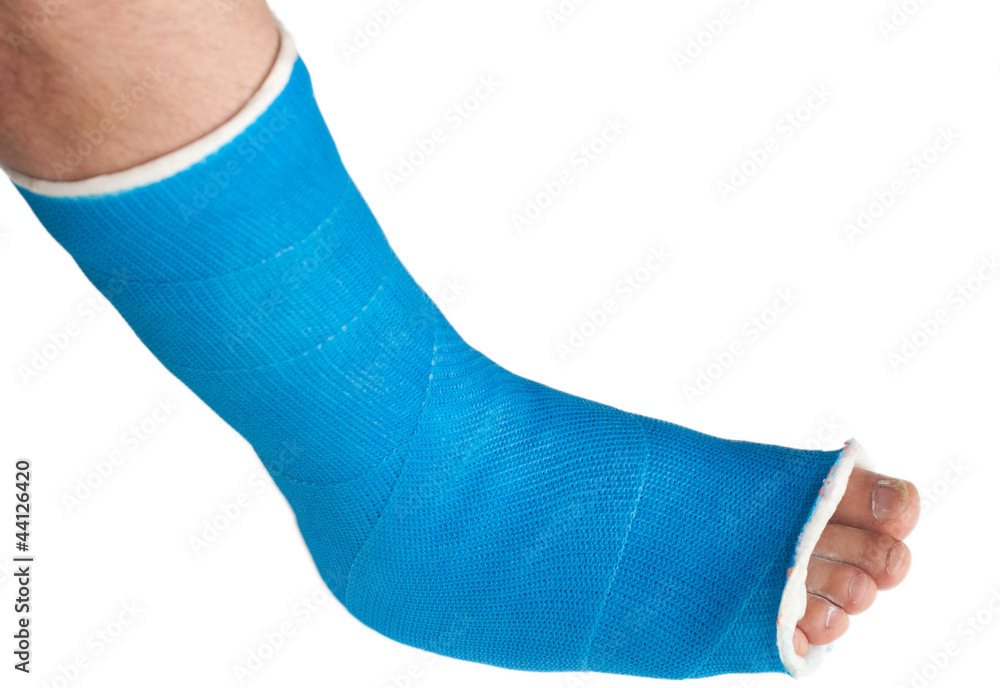 Broken Leg Blue Cast Stock Photo 1662826642