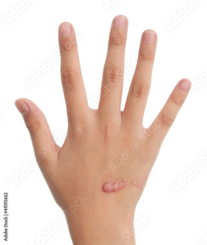 hands of the child with scar