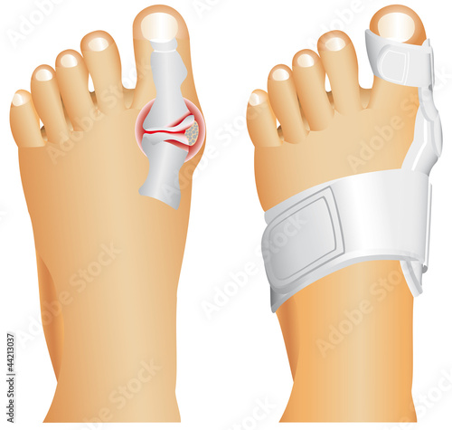Hallux valgus, popularly known as Bunion.