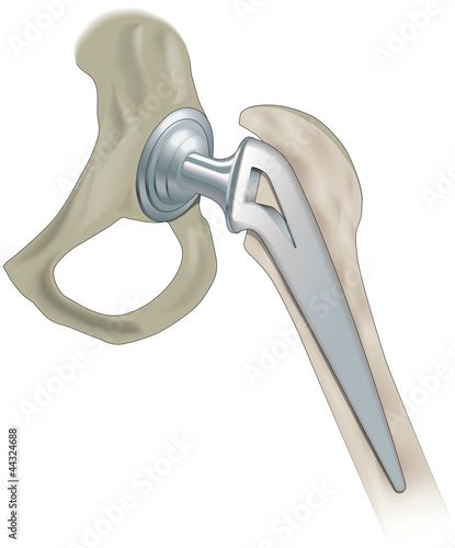Replacement hip joint, artificial joint