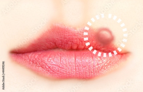 Close up of lips affected by herpes (cold sore)
