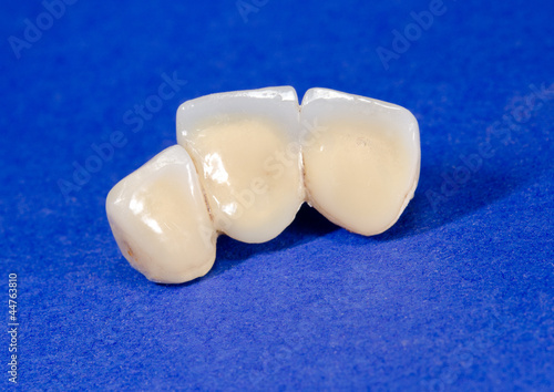 extrahierte Frontzahnbrücke von hinten