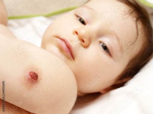 BCG vaccination wound on baby shoulder photo