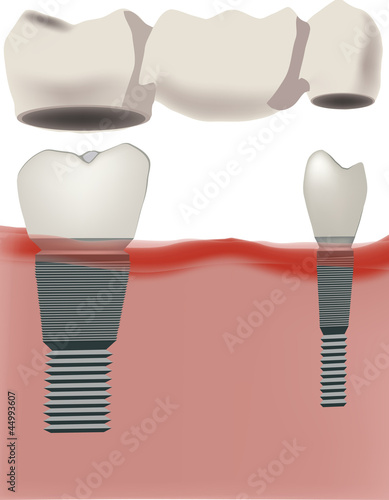 Dental implants with bridge