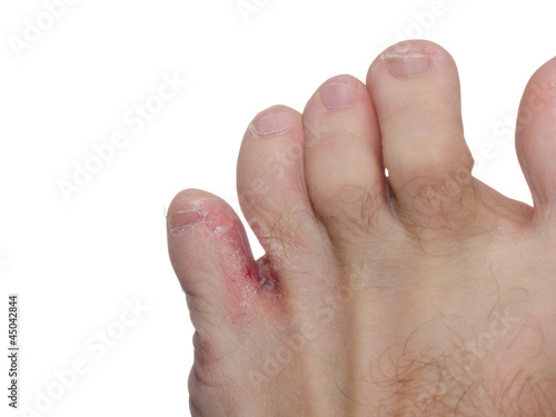 Athlete's foot (tinea pedis) © roblan