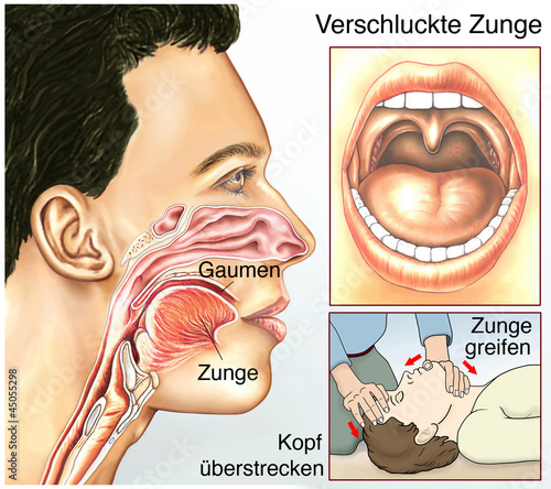 Zunge verschluckt.Erstickungsanfall.Erste Hilfe photo