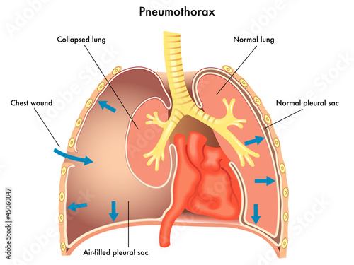Pneumotorace