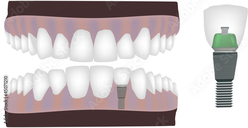 dental prosthesis