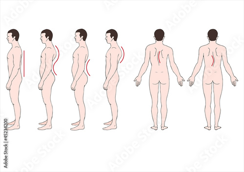 educational illustration deformstion of the spine 