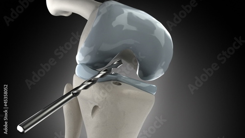 Knee arthroscopic cruciate ligament replacement stage photo