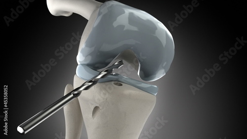 Knee arthroscopic cruciate ligament replacement stage