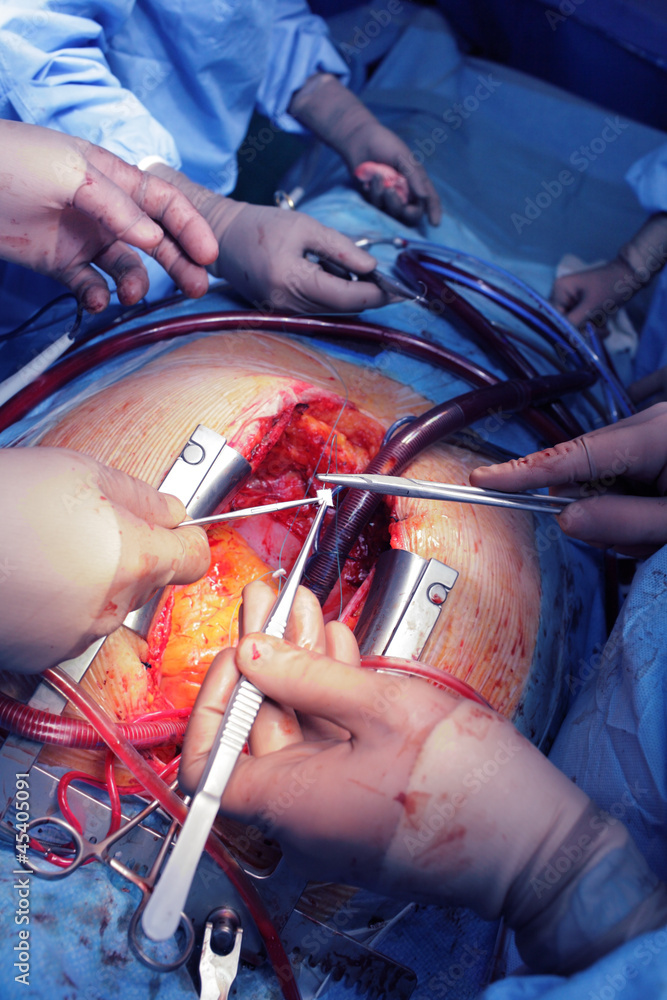 Obraz premium Teamwork of surgeons on the open heart