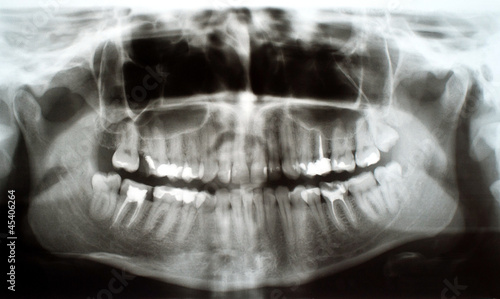 Dental xray