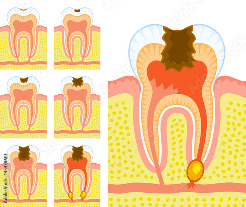 Internal structure of tooth (decay and caries)