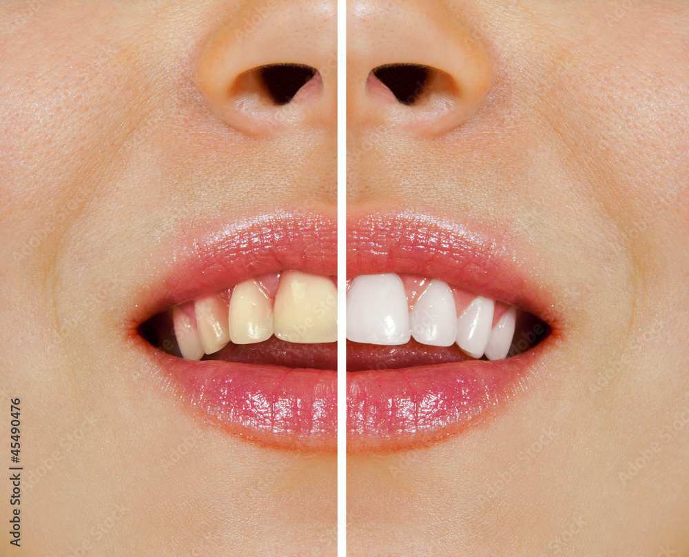 Naklejka premium teeth before and after whitening