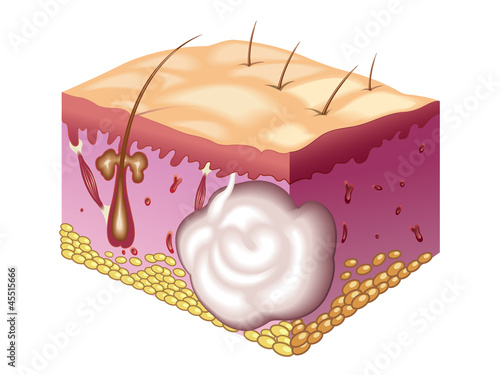 ciste sebacea