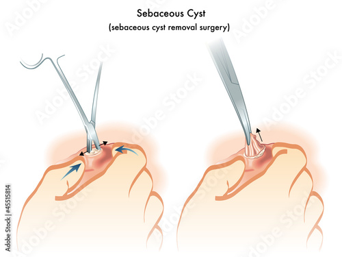 ciste sebacea